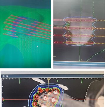 How an Oncorad medical team used 3D printing to treat a patient with a rare cancer The treatment was carried out by specialists at Littoral Clinic Ain Diab, part of the Oncorad Group University Hospital Centre Ibn Rochd.