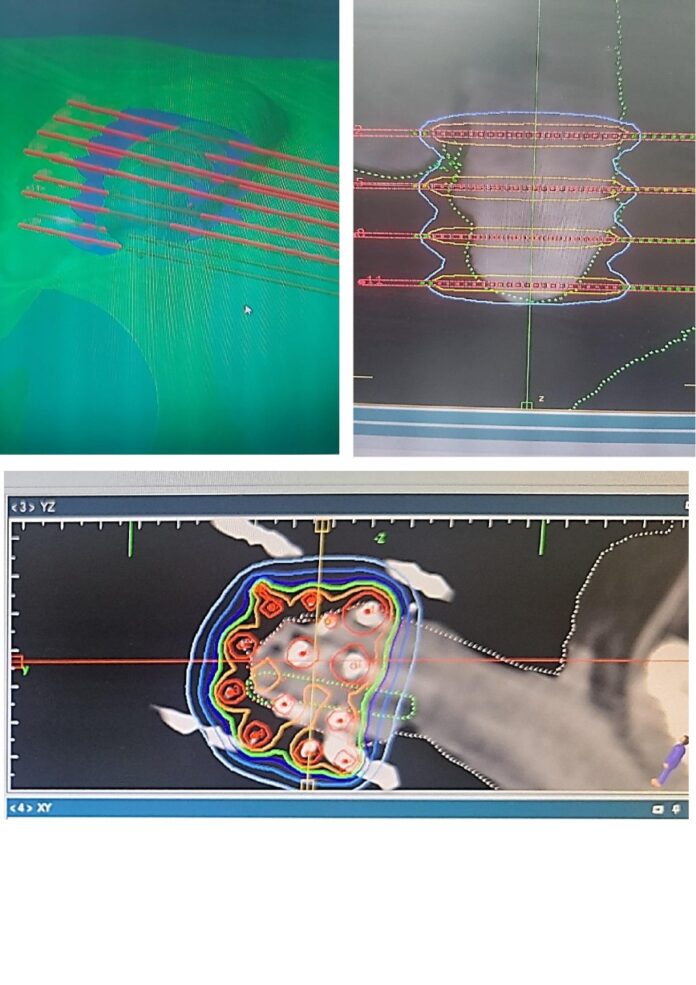 The treatment was carried out by specialists at Littoral Clinic Ain Diab, part of the Oncorad Group University Hospital Centre Ibn Rochd.